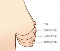 胸部下垂有什么危害？