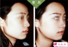 颧骨降低术的适用人群，哪些人不能做颧骨降低术