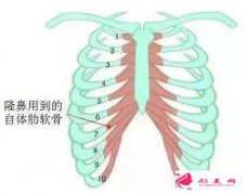 自体软骨隆鼻的恢复时间