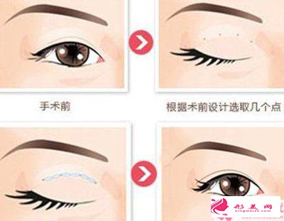 如何选择开内外眼角_开内眼角好还是开外眼角？