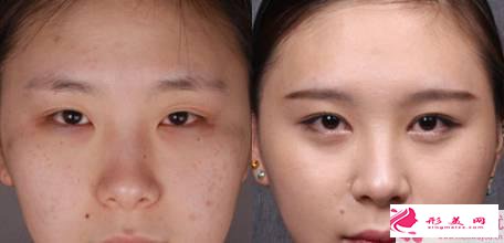 如何选择开内外眼角_开内眼角好还是开外眼角？