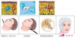 面部吸脂能减多少脂肪？
