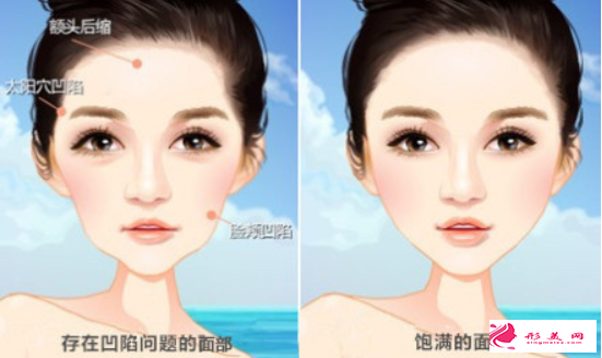 自体脂肪填充面部会失败吗