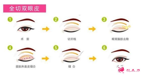 割双眼皮对比图，光看这些图片就能感受到手术的优势