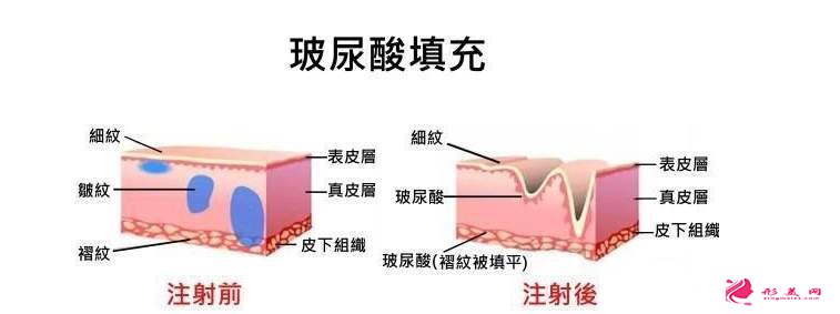玻尿酸一支多少钱？注射后多久定型？