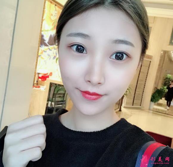 深圳回来医疗整形医院脂肪填充案例，院长技术很不错~