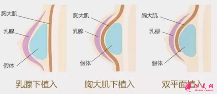 假体隆胸后会下坠吗