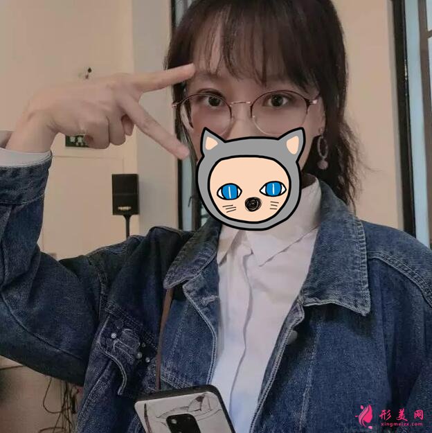 深圳叶琳双眼皮案例，把小姐姐的美分享给大家