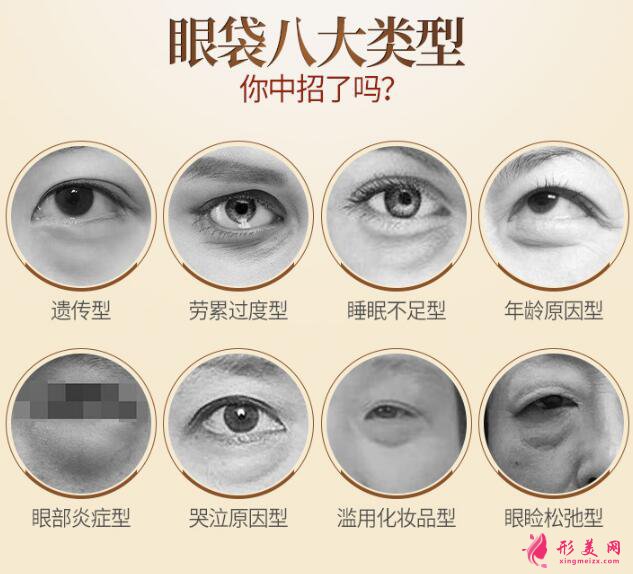 内切祛眼袋效果怎么样?