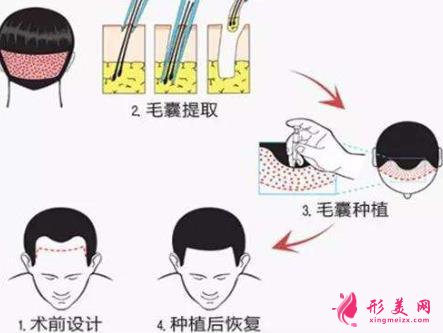 种植头发的价格表更新发布,附上种植头发案例!