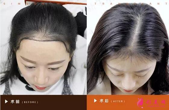 种植头发哪里好?