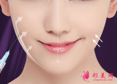 打完瘦脸针几天有效果？