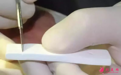 隆鼻假体取出后会有什么伤害吗？