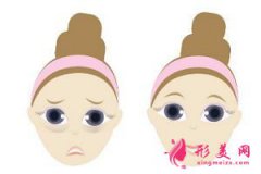 抽脂法去眼袋有什么优势？