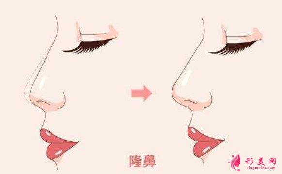 硅胶假体隆鼻能保持多少年