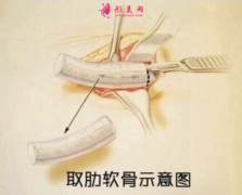 当代医学美容医院自体肋软骨隆鼻怎么样？有什么后遗症吗