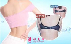 射频溶脂瘦后背的效果怎么样？