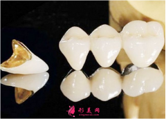 烤瓷牙材料哪种比较好？种类价格~