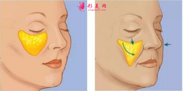 自体脂肪填充泪沟