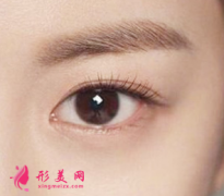 开眼角术后会回缩吗？