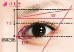 开内眼角疤痕增生能消下去吗？