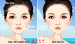 面部脂肪填充需要注射几次？