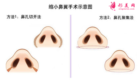 鼻翼缩小术后痛不痛