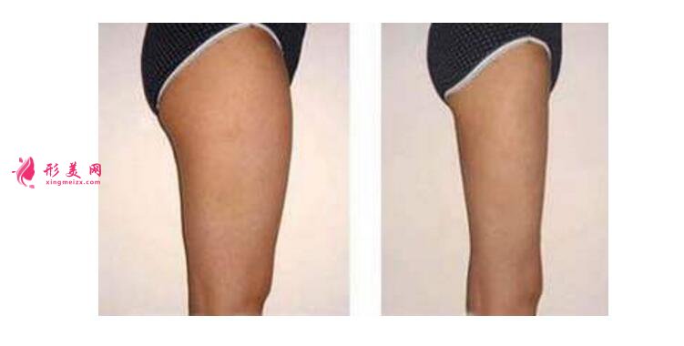 小腿吸脂减肥效果