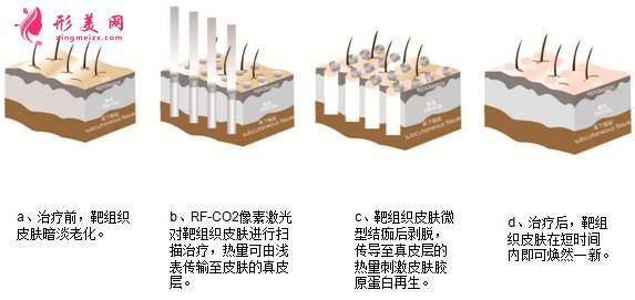 像素激光多少钱一次