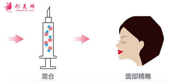 脸部自体脂肪填充价格