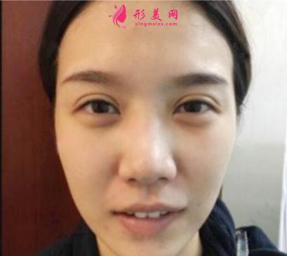 成都美立方整形医院隆鼻案例 术后恢复效果反馈 