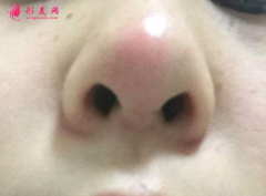 假体隆鼻后鼻尖发红怎么回事？