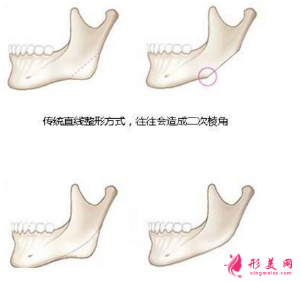 下颌角切除一般多少钱