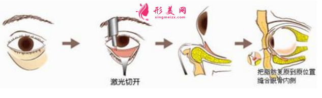 激光去眼袋要多少钱