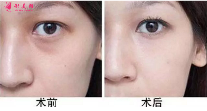 什么是眼袋?祛眼袋有哪些优势呢?
