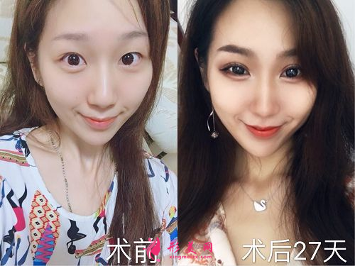 深圳非凡整形郭羡做双眼皮怎么样？收费标准？案例分享