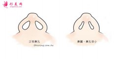 上海整形医院鼻翼整形的价格是多少？术后注意事项~