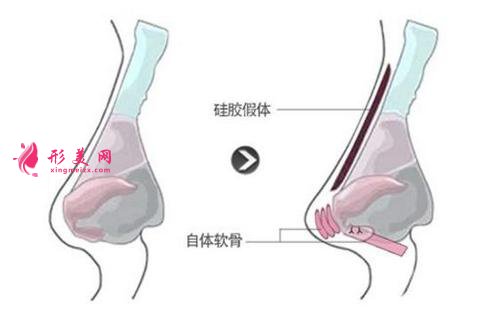 硅胶垫鼻梁维多少年