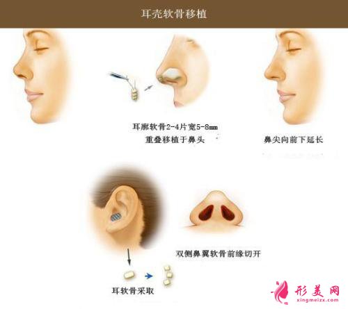 硅胶垫鼻梁维多少年