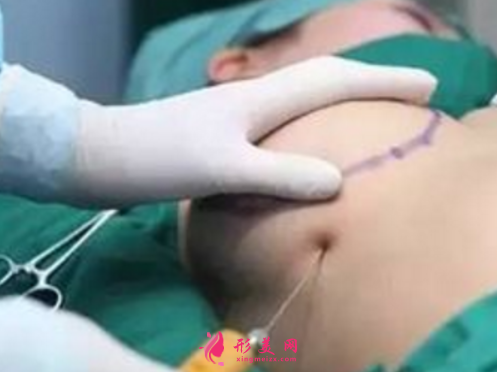自体脂肪隆胸需要注意的风险问题