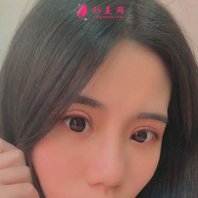 厦门华美医疗美容门诊部眼部多项案例