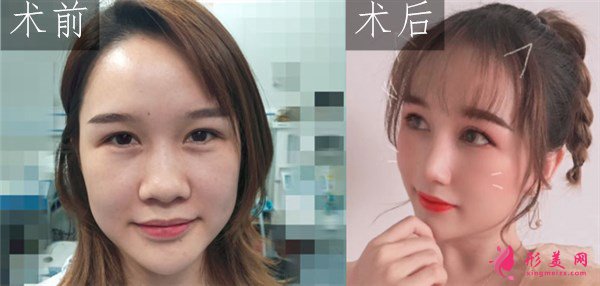武汉韩辰医疗美容鼻部多项案例 
