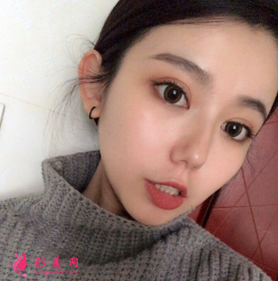 深圳非凡整形医院梅够明隆鼻手术