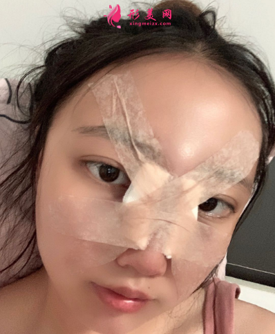 上海东方丽人整形医院乔海初隆鼻 上海东方丽人整形医院乔海初隆鼻