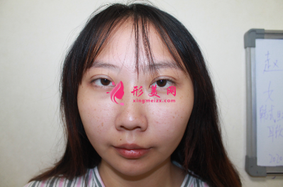 上海东方丽人整形医院乔海初隆鼻 上海东方丽人整形医院乔海初隆鼻