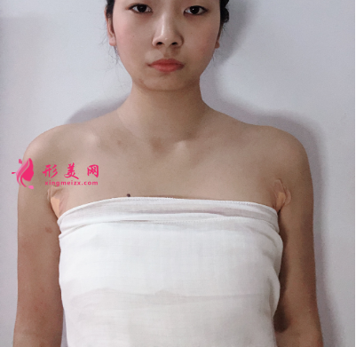 上海港华整形医院吕金陵丰胸案例