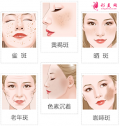 激光祛斑效果维持时间是多久？