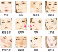 广州美莱激光祛斑要多少钱呢？