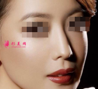 自体软骨隆鼻好不好呢？