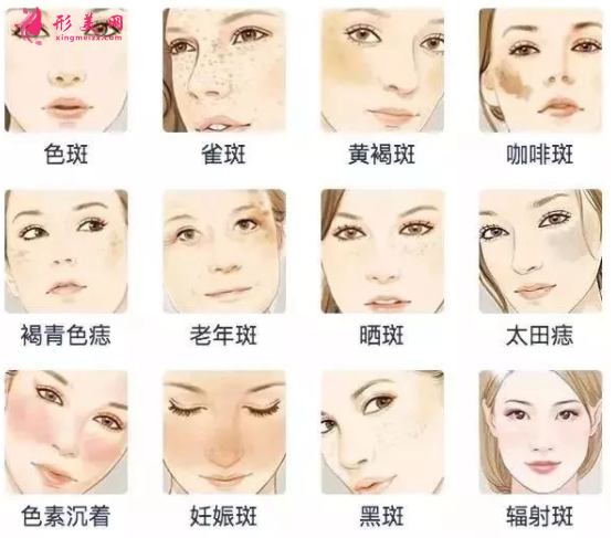 激光祛斑对皮肤健康有影响吗